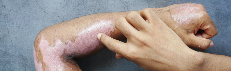 burn injury on arms that are about to heal